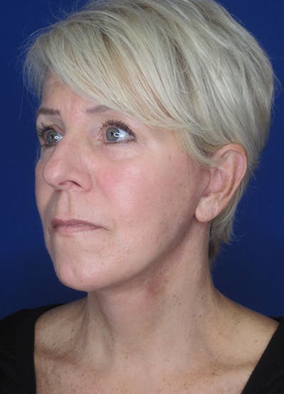 Facelift/Mini-Facelift Before & After Gallery - Patient 91755406 - Image 8