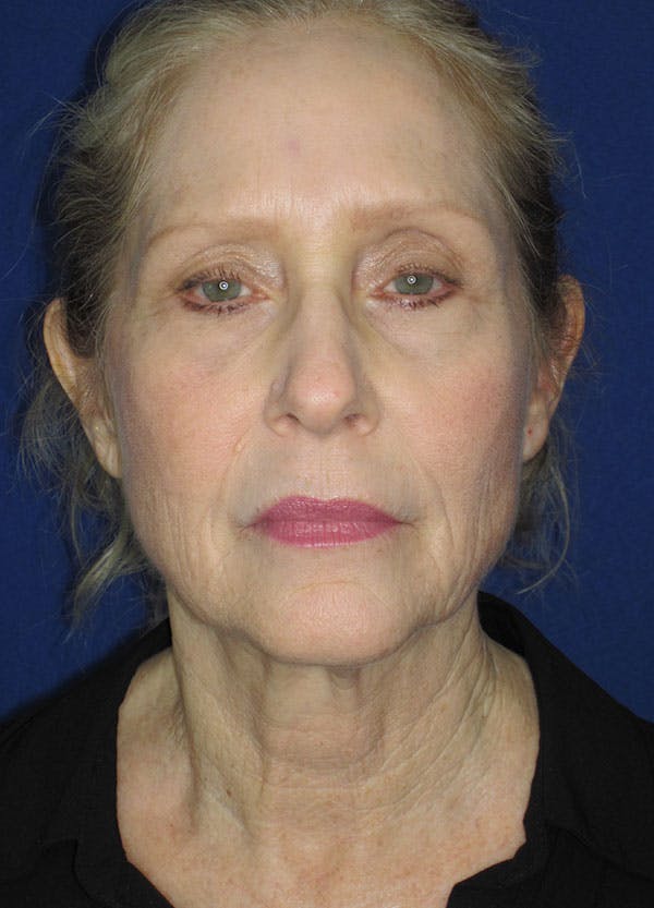 Facelift/Mini-Facelift Before & After Gallery - Patient 91755407 - Image 1