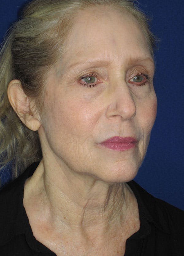 Facelift/Mini-Facelift Before & After Gallery - Patient 91755407 - Image 3