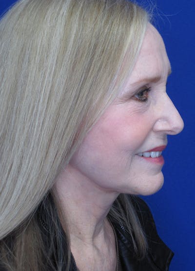 Facelift/Mini-Facelift Before & After Gallery - Patient 91755407 - Image 8