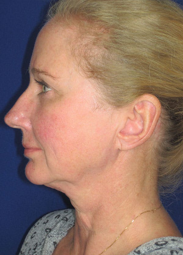 Facelift/Mini-Facelift Before & After Gallery - Patient 91755408 - Image 1