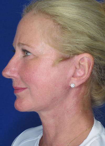 Facelift/Mini-Facelift Before & After Gallery - Patient 91755408 - Image 2