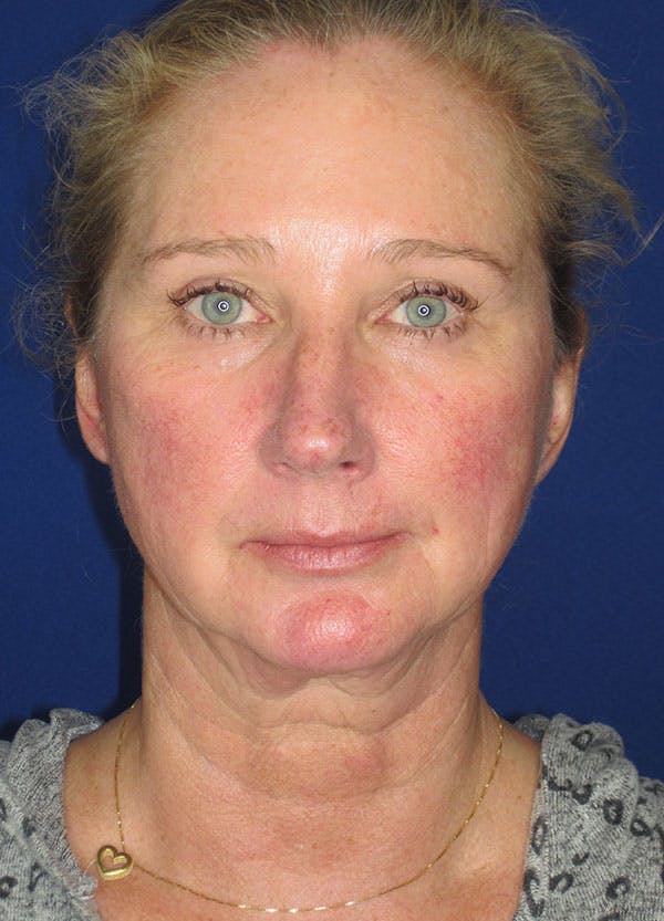 Facelift/Mini-Facelift Before & After Gallery - Patient 91755408 - Image 3