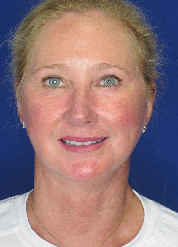 Facelift/Mini-Facelift Before & After Gallery - Patient 91755408 - Image 4