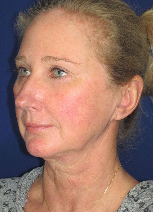 Facelift/Mini-Facelift Before & After Gallery - Patient 91755408 - Image 5
