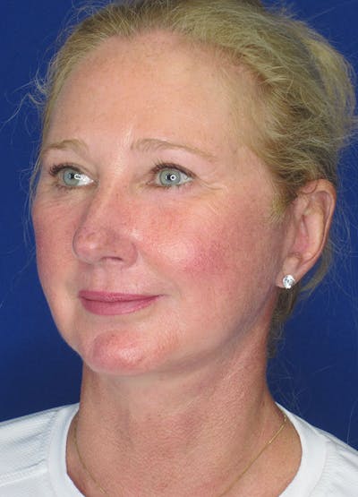 Facelift/Mini-Facelift Before & After Gallery - Patient 91755408 - Image 6