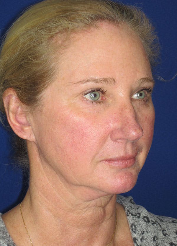 Facelift/Mini-Facelift Before & After Gallery - Patient 91755408 - Image 7
