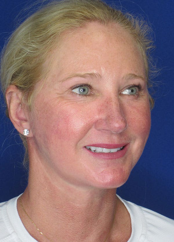 Facelift/Mini-Facelift Before & After Gallery - Patient 91755408 - Image 8