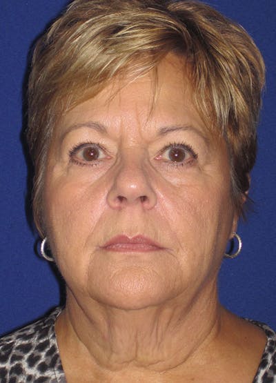 Facelift/Mini-Facelift Before & After Gallery - Patient 91755409 - Image 1