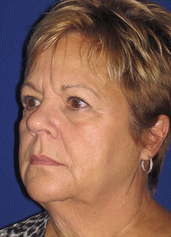 Facelift/Mini-Facelift Before & After Gallery - Patient 91755409 - Image 3