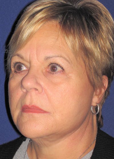Facelift/Mini-Facelift Before & After Gallery - Patient 91755409 - Image 4