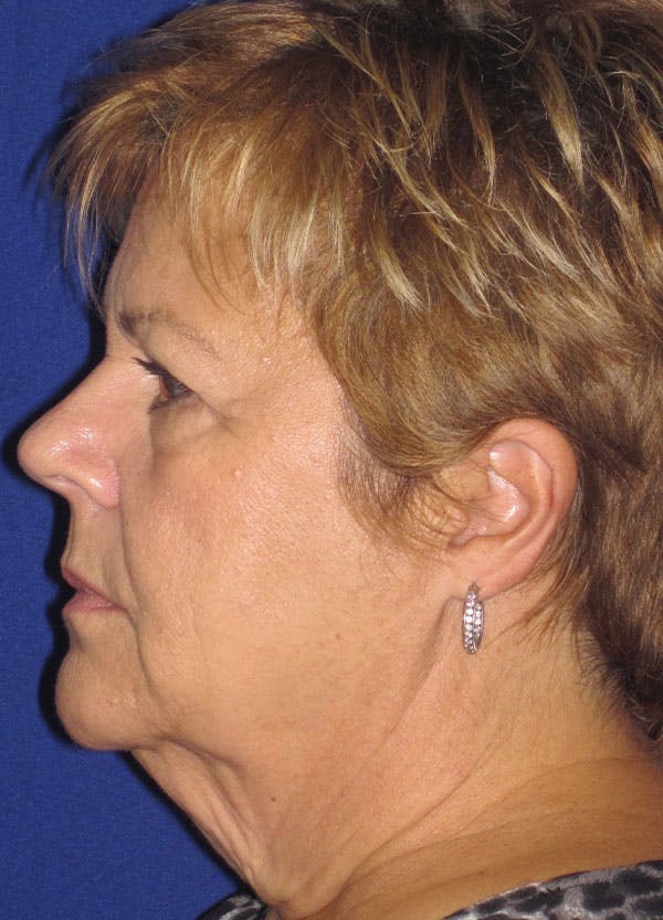 Facelift/Mini-Facelift Before & After Gallery - Patient 91755409 - Image 5