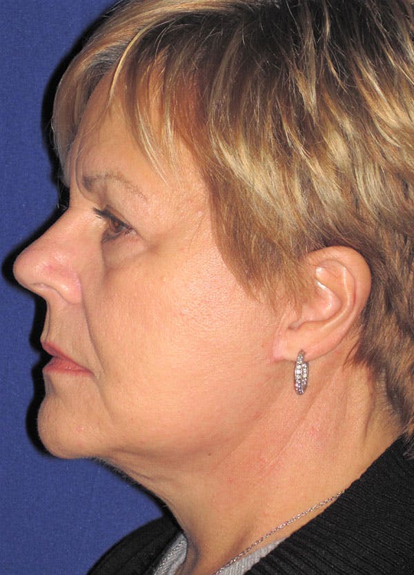 Facelift/Mini-Facelift Before & After Gallery - Patient 91755409 - Image 6