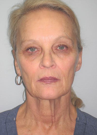 Facelift/Mini-Facelift Before & After Gallery - Patient 91755410 - Image 1