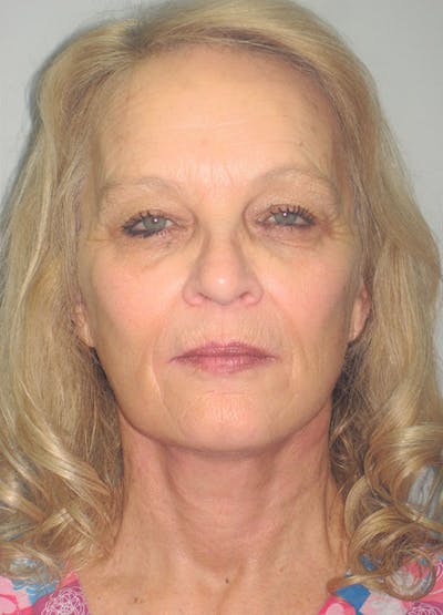 Facelift/Mini-Facelift Before & After Gallery - Patient 91755410 - Image 2