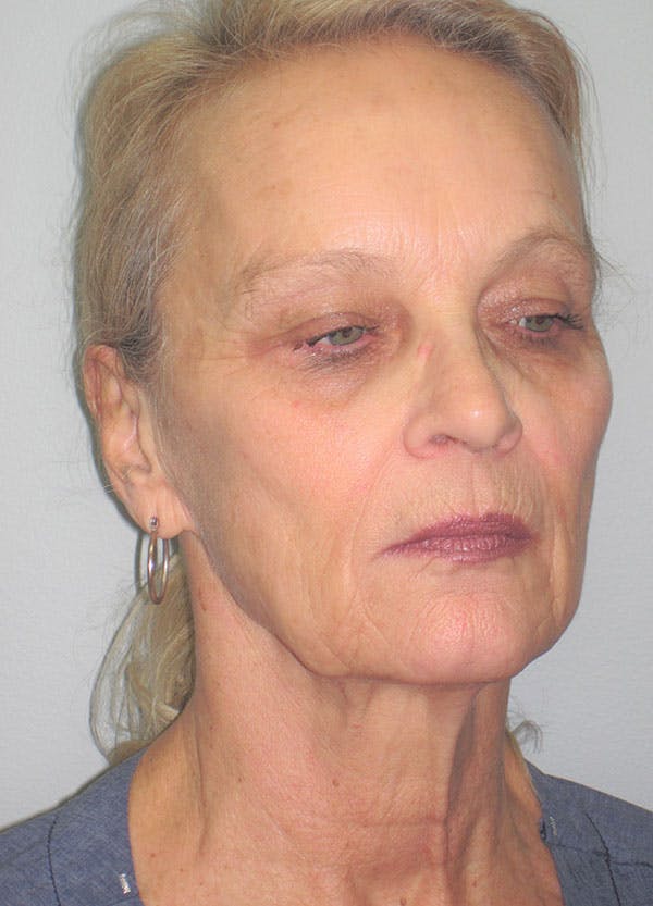 Facelift/Mini-Facelift Before & After Gallery - Patient 91755410 - Image 3