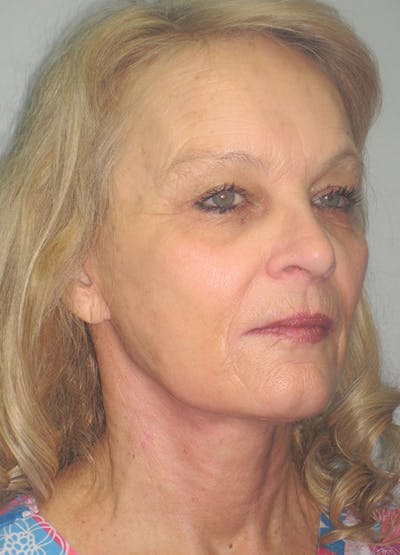 Facelift/Mini-Facelift Before & After Gallery - Patient 91755410 - Image 4
