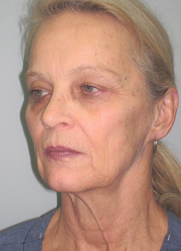 Facelift/Mini-Facelift Before & After Gallery - Patient 91755410 - Image 5