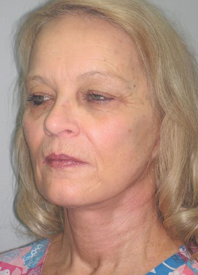 Facelift/Mini-Facelift Before & After Gallery - Patient 91755410 - Image 6