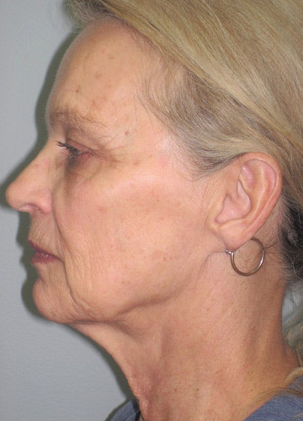 Facelift/Mini-Facelift Before & After Gallery - Patient 91755410 - Image 7