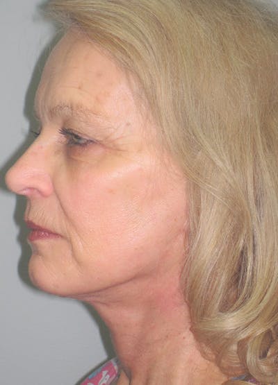 Facelift/Mini-Facelift Before & After Gallery - Patient 91755410 - Image 8