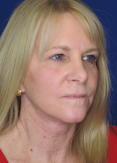 Facelift/Mini-Facelift Before & After Gallery - Patient 91755411 - Image 2