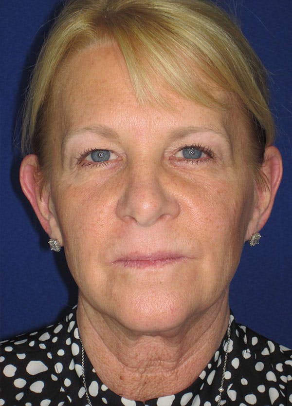 Facelift/Mini-Facelift Before & After Gallery - Patient 91755411 - Image 3