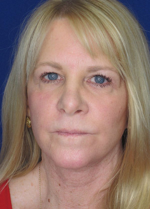 Facelift/Mini-Facelift Before & After Gallery - Patient 91755411 - Image 4