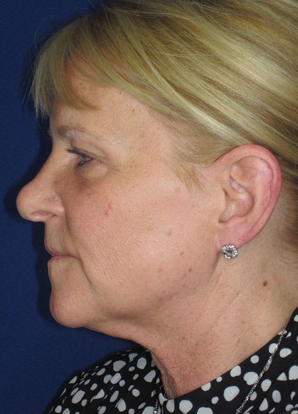 Facelift/Mini-Facelift Before & After Gallery - Patient 91755411 - Image 5