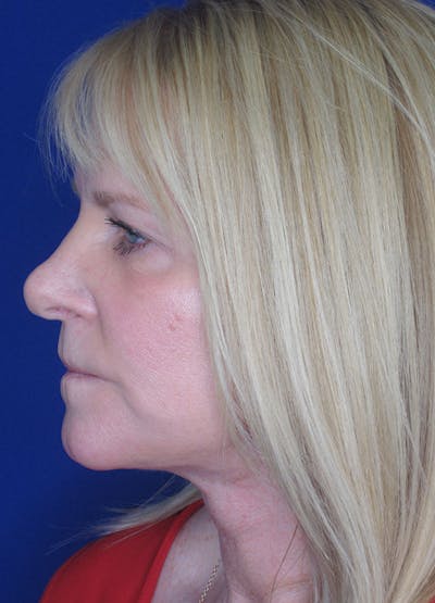 Facelift/Mini-Facelift Before & After Gallery - Patient 91755411 - Image 6