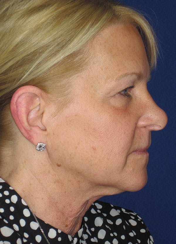 Facelift/Mini-Facelift Before & After Gallery - Patient 91755411 - Image 7