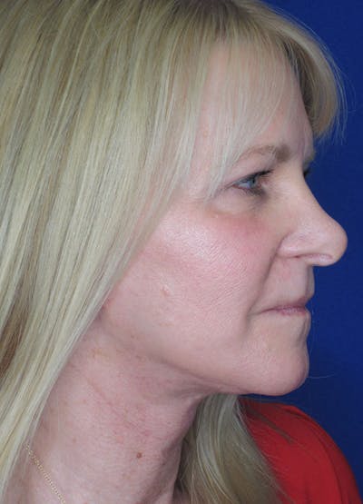 Facelift/Mini-Facelift Before & After Gallery - Patient 91755411 - Image 8