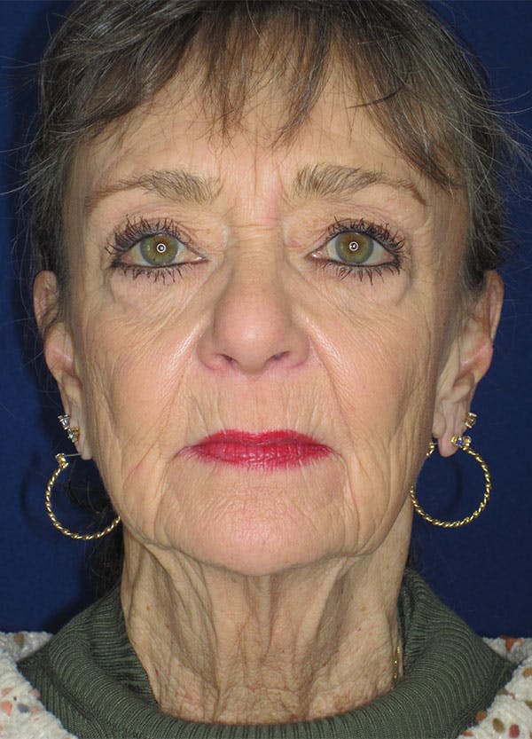 Facelift/Mini-Facelift Before & After Gallery - Patient 91755412 - Image 1