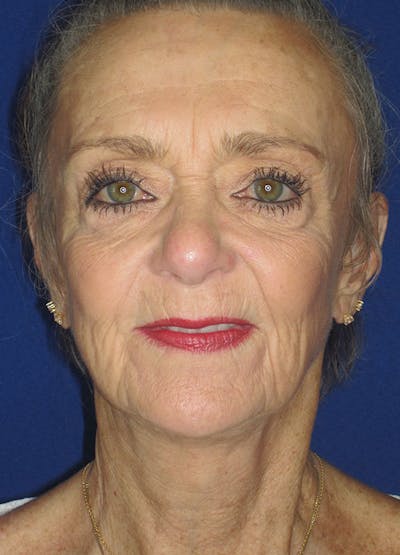 Facelift/Mini-Facelift Before & After Gallery - Patient 91755412 - Image 2