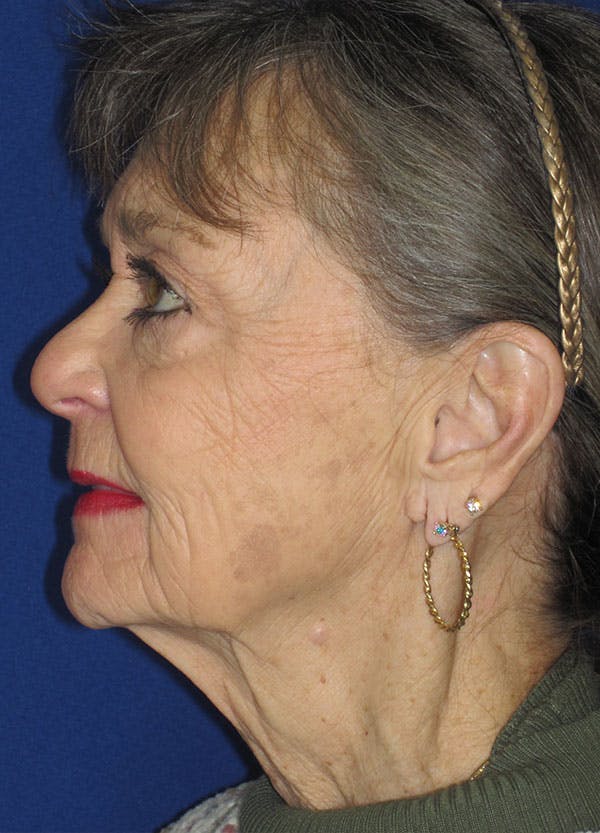 Facelift/Mini-Facelift Before & After Gallery - Patient 91755412 - Image 3
