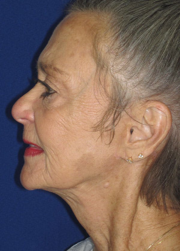 Facelift/Mini-Facelift Before & After Gallery - Patient 91755412 - Image 4
