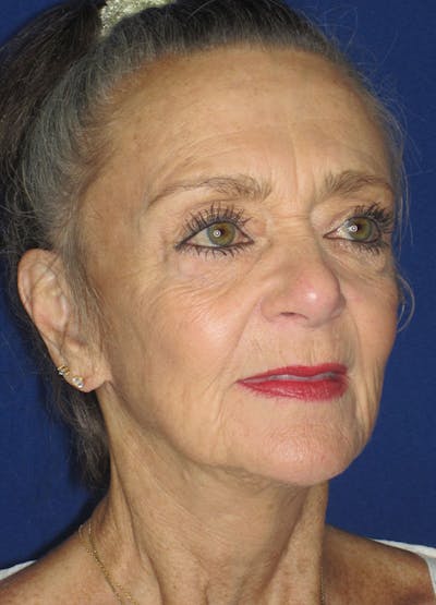 Facelift/Mini-Facelift Before & After Gallery - Patient 91755412 - Image 6