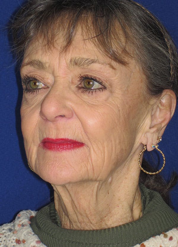 Facelift/Mini-Facelift Before & After Gallery - Patient 91755412 - Image 7