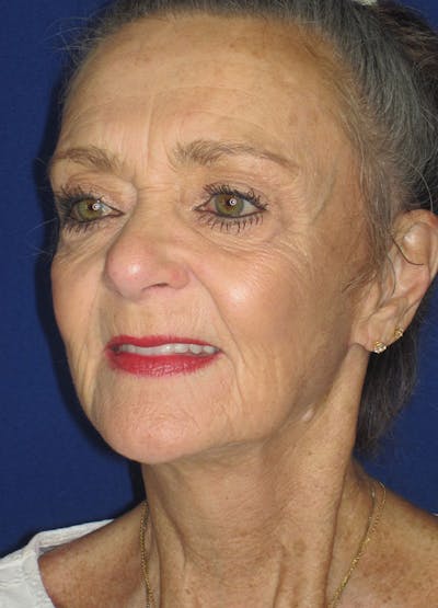 Facelift/Mini-Facelift Before & After Gallery - Patient 91755412 - Image 8