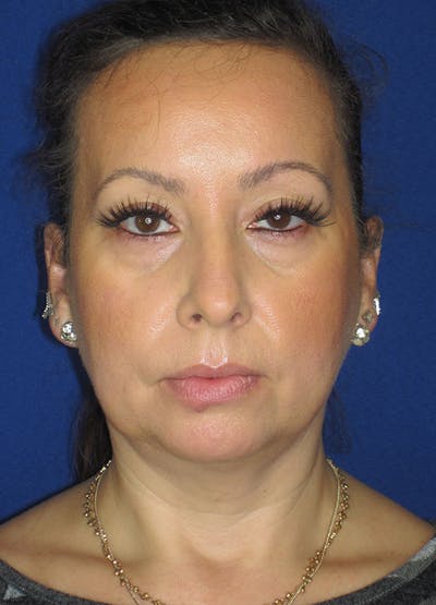 Facelift/Mini-Facelift Before & After Gallery - Patient 91755413 - Image 1