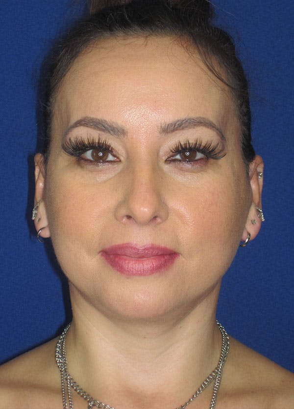 Facelift/Mini-Facelift Before & After Gallery - Patient 91755413 - Image 2