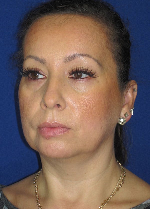 Facelift/Mini-Facelift Before & After Gallery - Patient 91755413 - Image 3