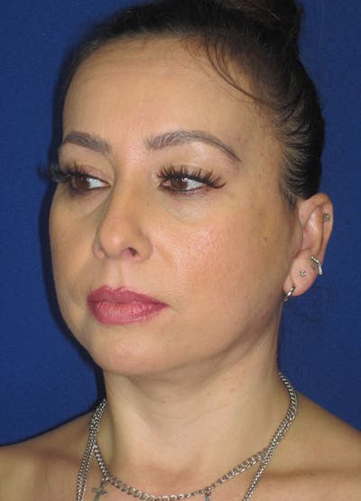 Facelift/Mini-Facelift Before & After Gallery - Patient 91755413 - Image 4