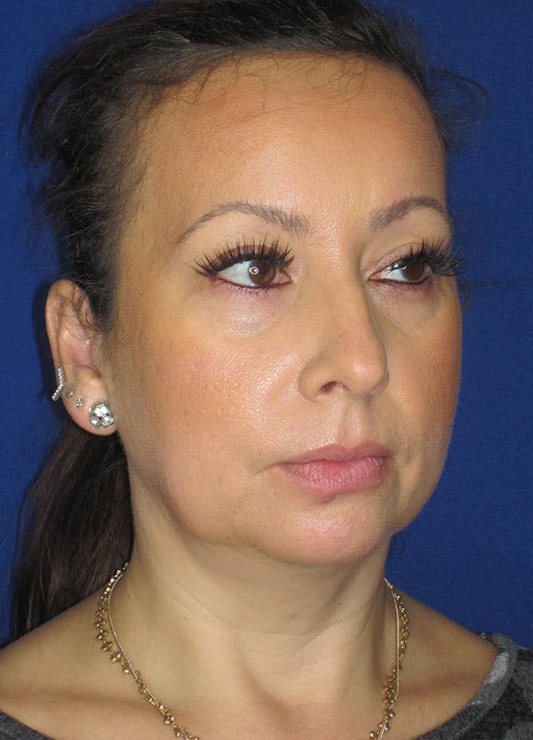 Facelift/Mini-Facelift Before & After Gallery - Patient 91755413 - Image 5