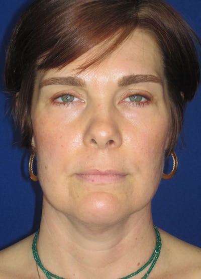 Facelift/Mini-Facelift Before & After Gallery - Patient 91755414 - Image 1