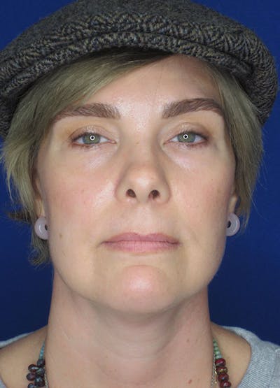 Facelift/Mini-Facelift Before & After Gallery - Patient 91755414 - Image 2