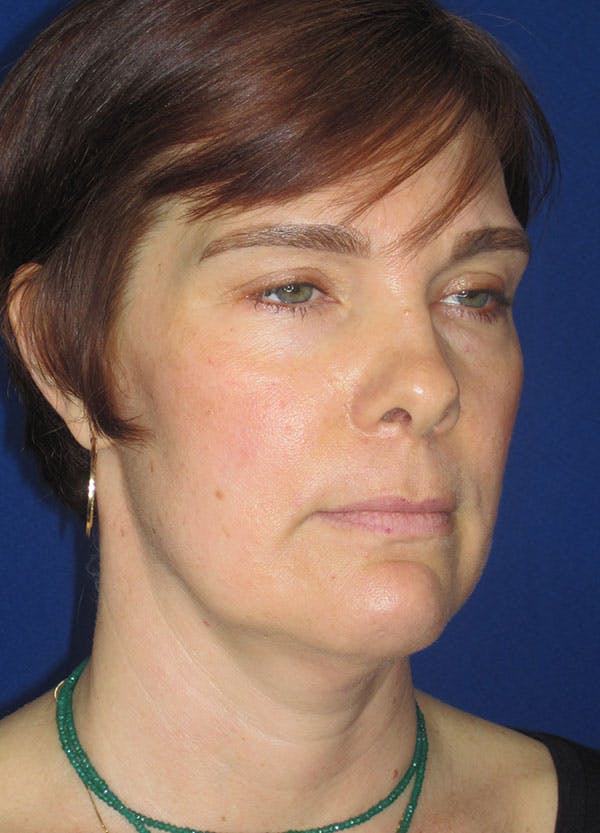 Facelift/Mini-Facelift Before & After Gallery - Patient 91755414 - Image 3