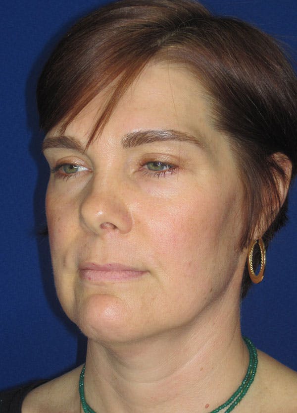 Facelift/Mini-Facelift Before & After Gallery - Patient 91755414 - Image 5