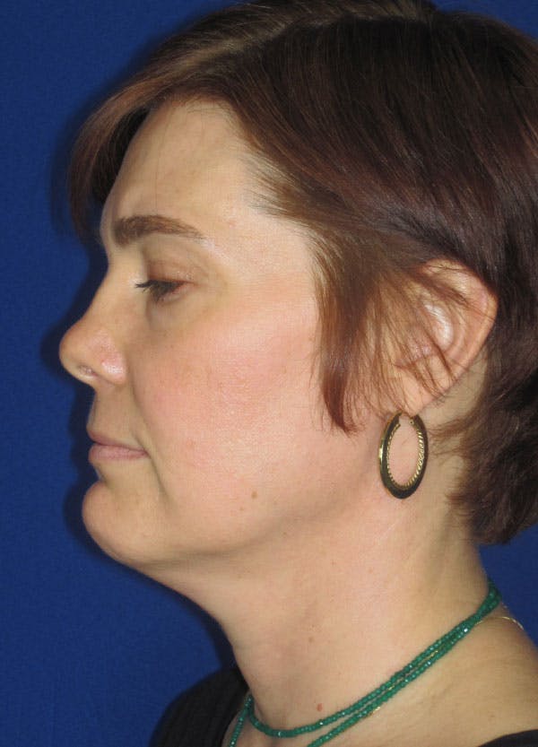 Facelift/Mini-Facelift Before & After Gallery - Patient 91755414 - Image 7