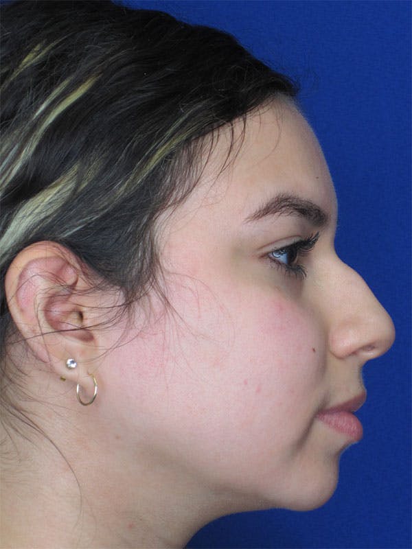 Rhinoplasty Before & After Gallery - Patient 92108549 - Image 3